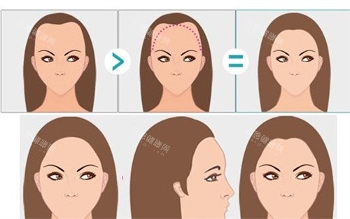 南京蘿愛美麗再生怎么樣?是植發(fā)實力機構(gòu),超微針技術(shù)單價親民成效直觀